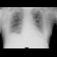 Interstitial lung edema: X-ray - Plain radiograph
